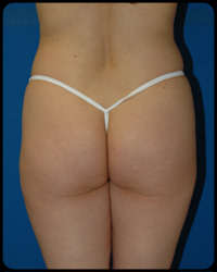 Gluteal Augmentation 