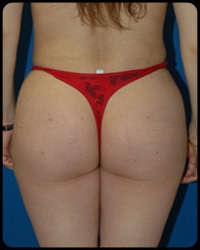 Gluteal Augmentation 