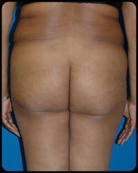 Gluteal Augmentation 