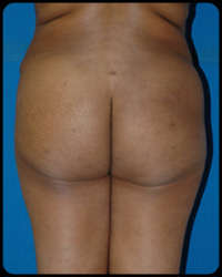 Gluteal Augmentation 