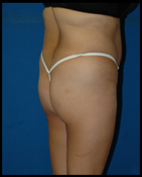 Gluteal Augmentation 