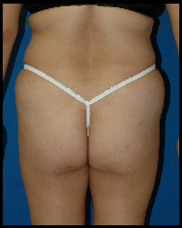 Gluteal Augmentation 