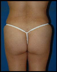 Gluteal Augmentation 