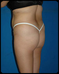 Gluteal Augmentation 