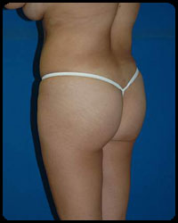 Gluteal Augmentation 