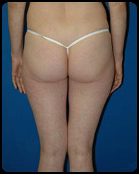 Gluteal Augmentation 