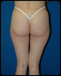 Gluteal Augmentation 