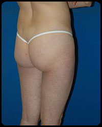 Gluteal Augmentation 