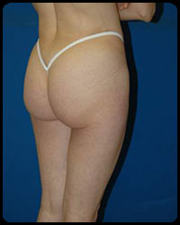 Gluteal Augmentation 