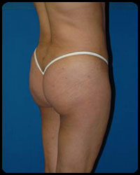 Gluteal Augmentation 