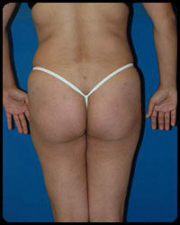 Gluteal Augmentation 