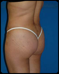 Gluteal Augmentation 