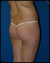 Gluteal Augmentation 