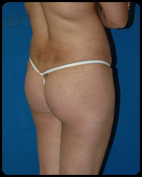 Gluteal Augmentation 