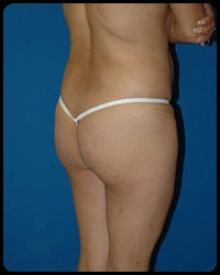 Gluteal Augmentation 