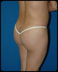 Gluteal Augmentation 