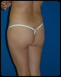 Gluteal Augmentation 