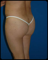 Gluteal Augmentation 