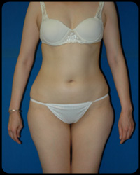 Liposuction and Body Contouring - Suction Assisted Lipectomy (SAL) 