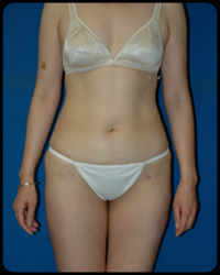 Liposuction and Body Contouring - Suction Assisted Lipectomy (SAL) 