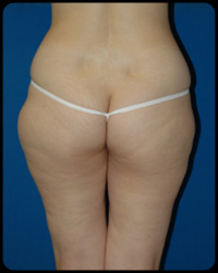 Liposuction and Body Contouring - Suction Assisted Lipectomy (SAL) 