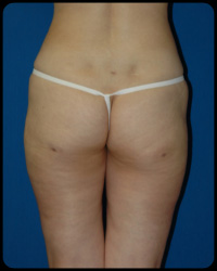 Liposuction and Body Contouring - Suction Assisted Lipectomy (SAL) 