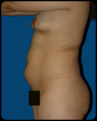 Liposuction and Body Contouring - Suction Assisted Lipectomy (SAL) 