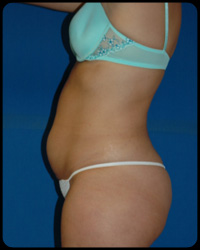 Liposuction and Body Contouring - Suction Assisted Lipectomy (SAL) 