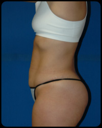 Liposuction and Body Contouring - Suction Assisted Lipectomy (SAL) 