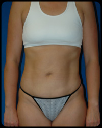 Liposuction and Body Contouring - Suction Assisted Lipectomy (SAL) 