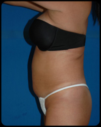 Liposuction and Body Contouring - Suction Assisted Lipectomy (SAL) 