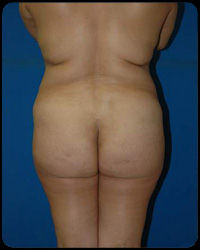 Liposuction and Body Contouring - Suction Assisted Lipectomy (SAL) 