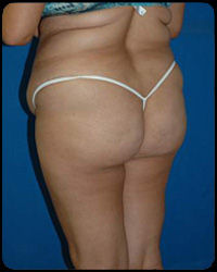 Liposuction and Body Contouring - Suction Assisted Lipectomy (SAL) 