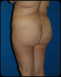 Liposuction and Body Contouring - Suction Assisted Lipectomy (SAL) 