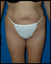 Liposuction and Body Contouring - Suction Assisted Lipectomy (SAL) 