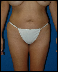 Liposuction and Body Contouring - Suction Assisted Lipectomy (SAL) 