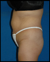 Liposuction and Body Contouring - Suction Assisted Lipectomy (SAL) 