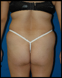 Liposuction and Body Contouring - Suction Assisted Lipectomy (SAL) 