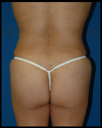 Liposuction and Body Contouring - Suction Assisted Lipectomy (SAL) 