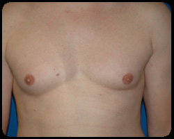 Liposuction and Body Contouring - Suction Assisted Lipectomy (SAL) 