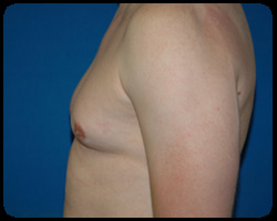 Liposuction and Body Contouring - Suction Assisted Lipectomy (SAL) 