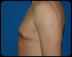 Liposuction and Body Contouring - Suction Assisted Lipectomy (SAL) 