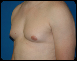 Liposuction and Body Contouring - Suction Assisted Lipectomy (SAL) 