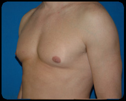 Liposuction and Body Contouring - Suction Assisted Lipectomy (SAL) 