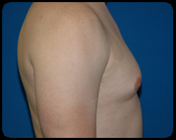 Liposuction and Body Contouring - Suction Assisted Lipectomy (SAL) 