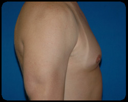 Liposuction and Body Contouring - Suction Assisted Lipectomy (SAL) 