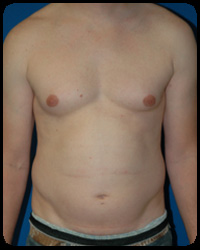 Liposuction and Body Contouring - Suction Assisted Lipectomy (SAL) 