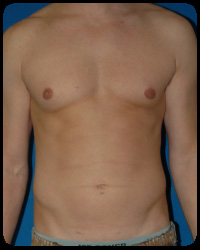 Liposuction and Body Contouring - Suction Assisted Lipectomy (SAL) 