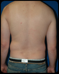 Liposuction and Body Contouring - Suction Assisted Lipectomy (SAL) 