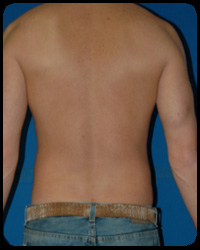 Liposuction and Body Contouring - Suction Assisted Lipectomy (SAL) 